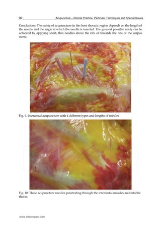 Yamamoto new scalp acupuncture | PDF
