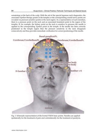 Yamamoto new scalp acupuncture | PDF