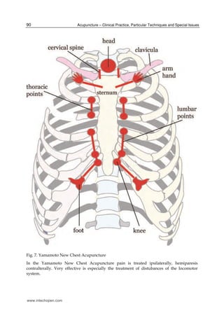 Yamamoto new scalp acupuncture | PDF