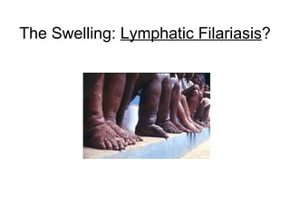 The Swelling:  Lymphatic Filariasis ? 