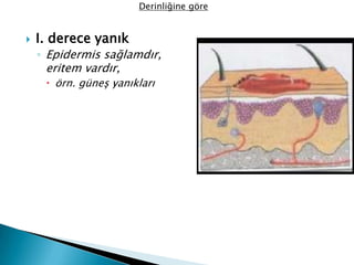  I. derece yanık
◦ Epidermis sağlamdır,
eritem vardır,
 örn. güneş yanıkları
Derinliğine göre
 
