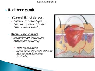  II. derece yanık
◦ Yüzeyel ikinci derece:
 Epidermis bütünlüğü
bozulmuş, dermisin üst
tabakalarına sınırlı ,
◦ Derin ikinci derece
 Dermisin alt (retiküler)
tabakaları tutulmuş
 Yüzeyel çok ağrılı
 Derin ikinci derecede daha az
ağrı ve künt bası hissi
hakimdir.
Derinliğine göre
 