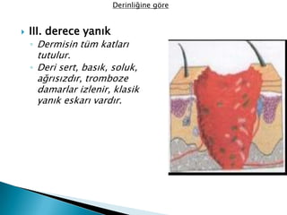  III. derece yanık
◦ Dermisin tüm katları
tutulur.
◦ Deri sert, basık, soluk,
ağrısızdır, tromboze
damarlar izlenir, klasik
yanık eskarı vardır.
Derinliğine göre
 