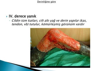  IV. derece yanık
◦ Cildin tüm katları, cilt altı yağ ve derin yapılar (kas,
tendon, vb) tutulur, kömürleşmiş görünüm vardır
Derinliğine göre
 