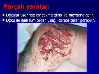 Parçalı yaralar:   Dokular üzerinde bir çekme etkisi ile meydana gelir.  Doku ile ilgili tüm organ , saçlı deride zarar görebilir. 