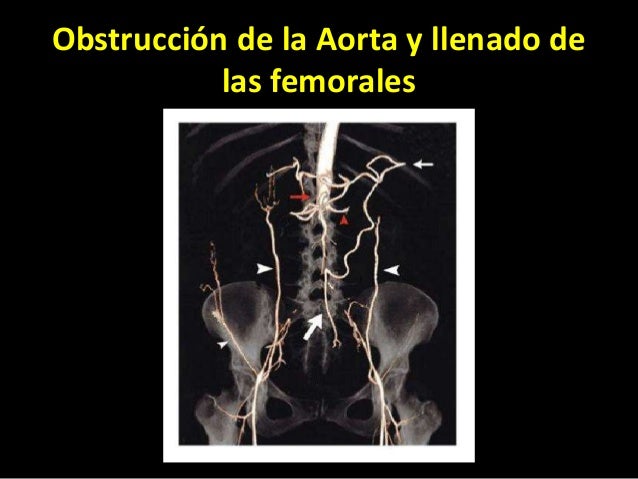 A los asteriscos vasculares es posible el masaje contra la celulitis