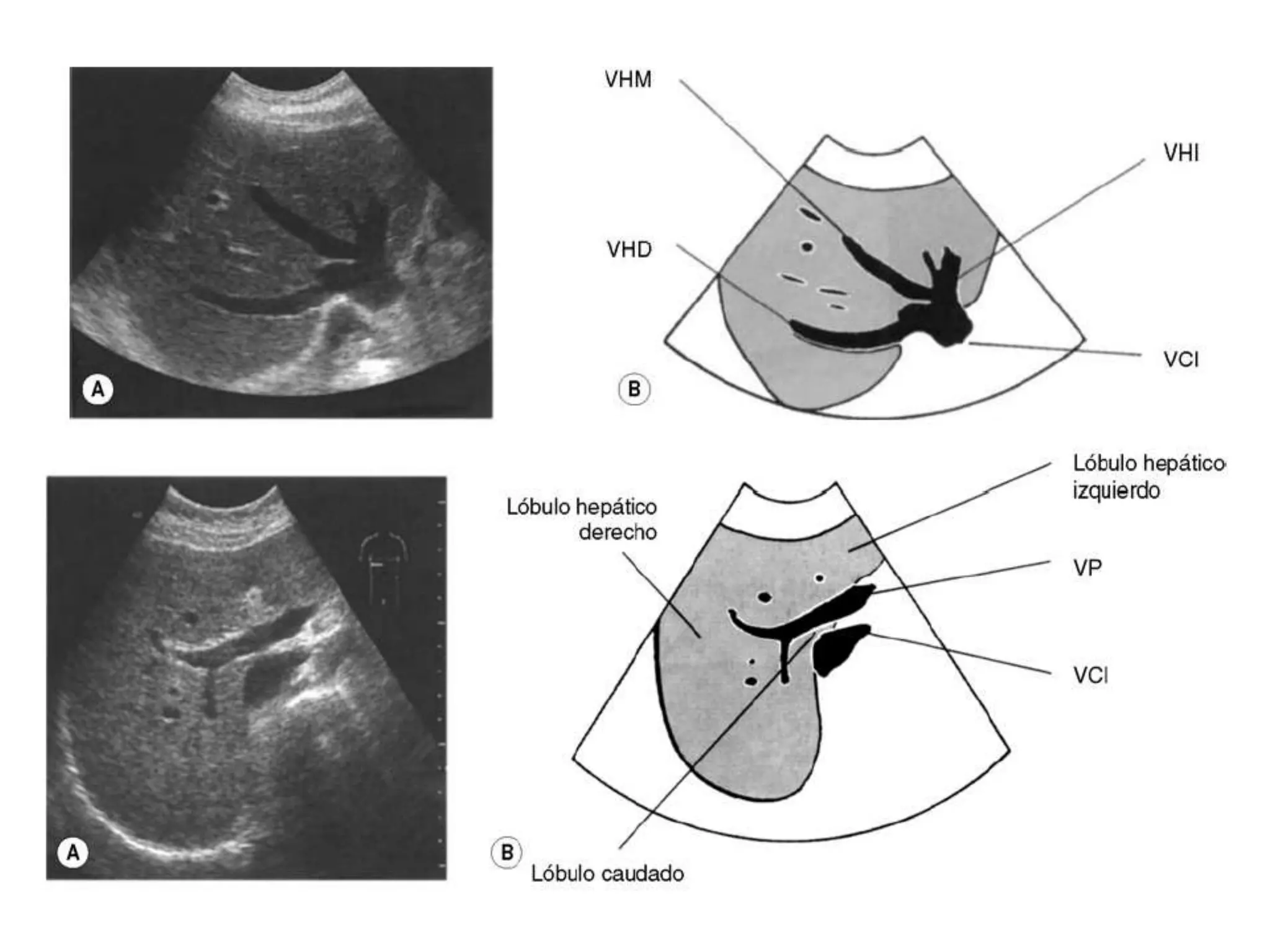 Ecografía normal de hígado y Ecografía Doppler de Vasos Hepáticos | PDF
