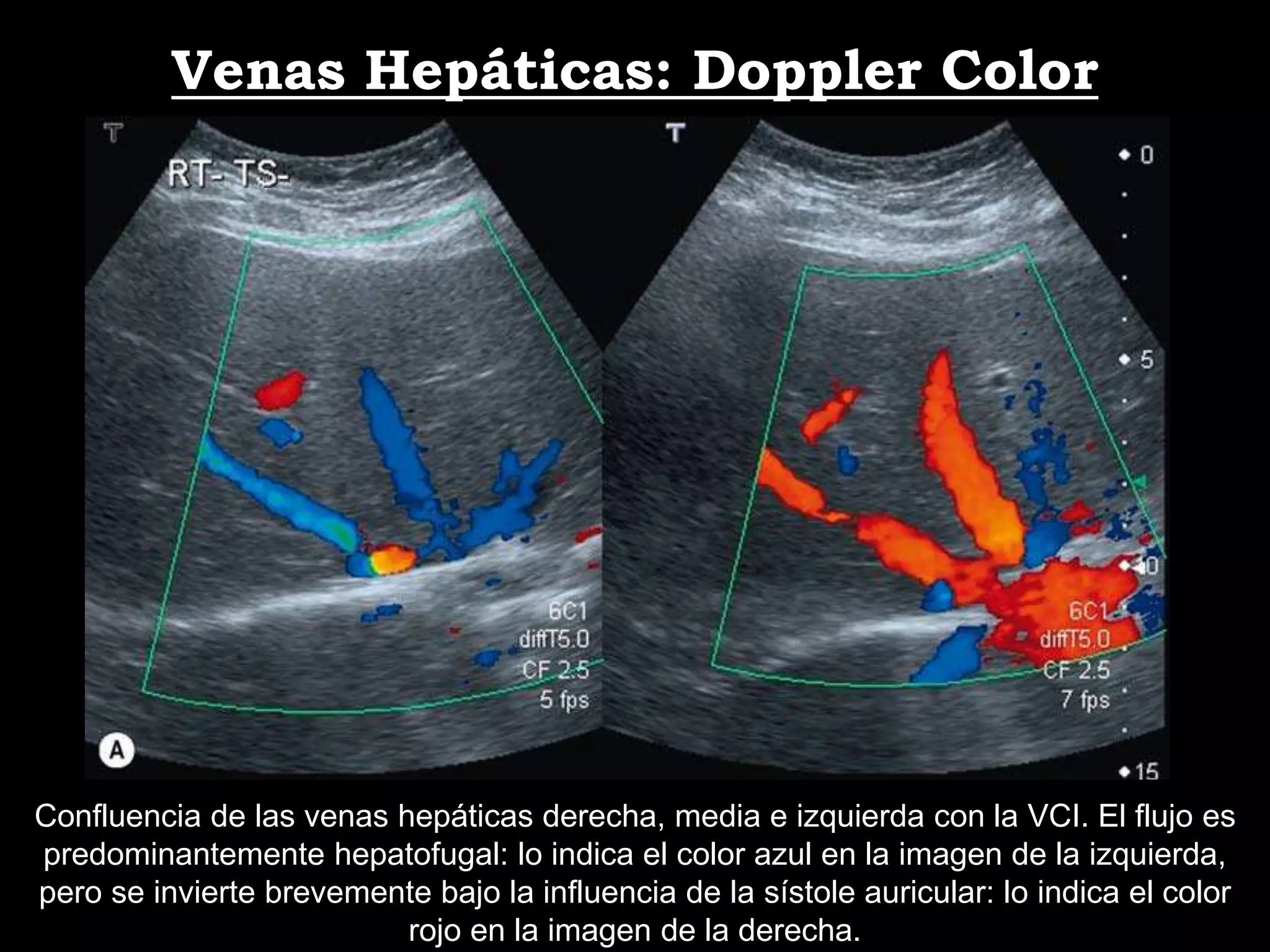 Ecografía normal de hígado y Ecografía Doppler de Vasos Hepáticos | PDF