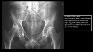 Radiología de la Osteoartrosis