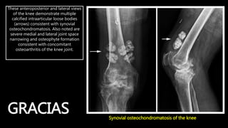 Radiología de la Osteoartrosis