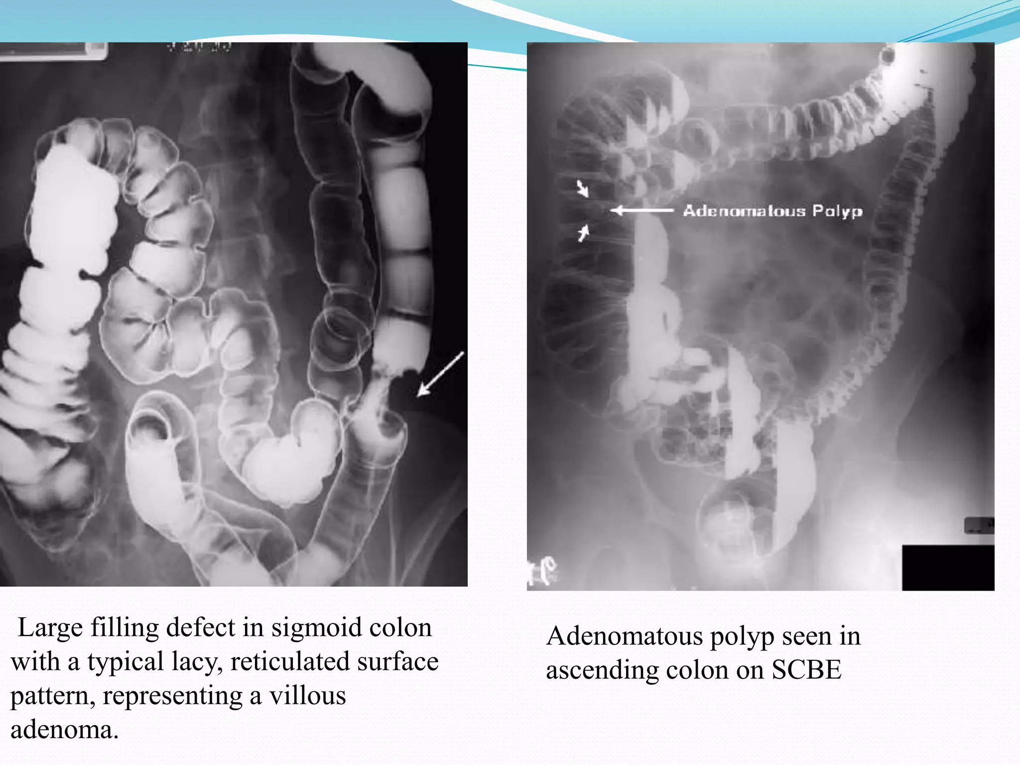 Large filling defect in sigmoid colon
with a typical lacy, reticulated surface
pattern, representing a villous
adenoma.
Adenomatous polyp seen in
ascending colon on SCBE
 