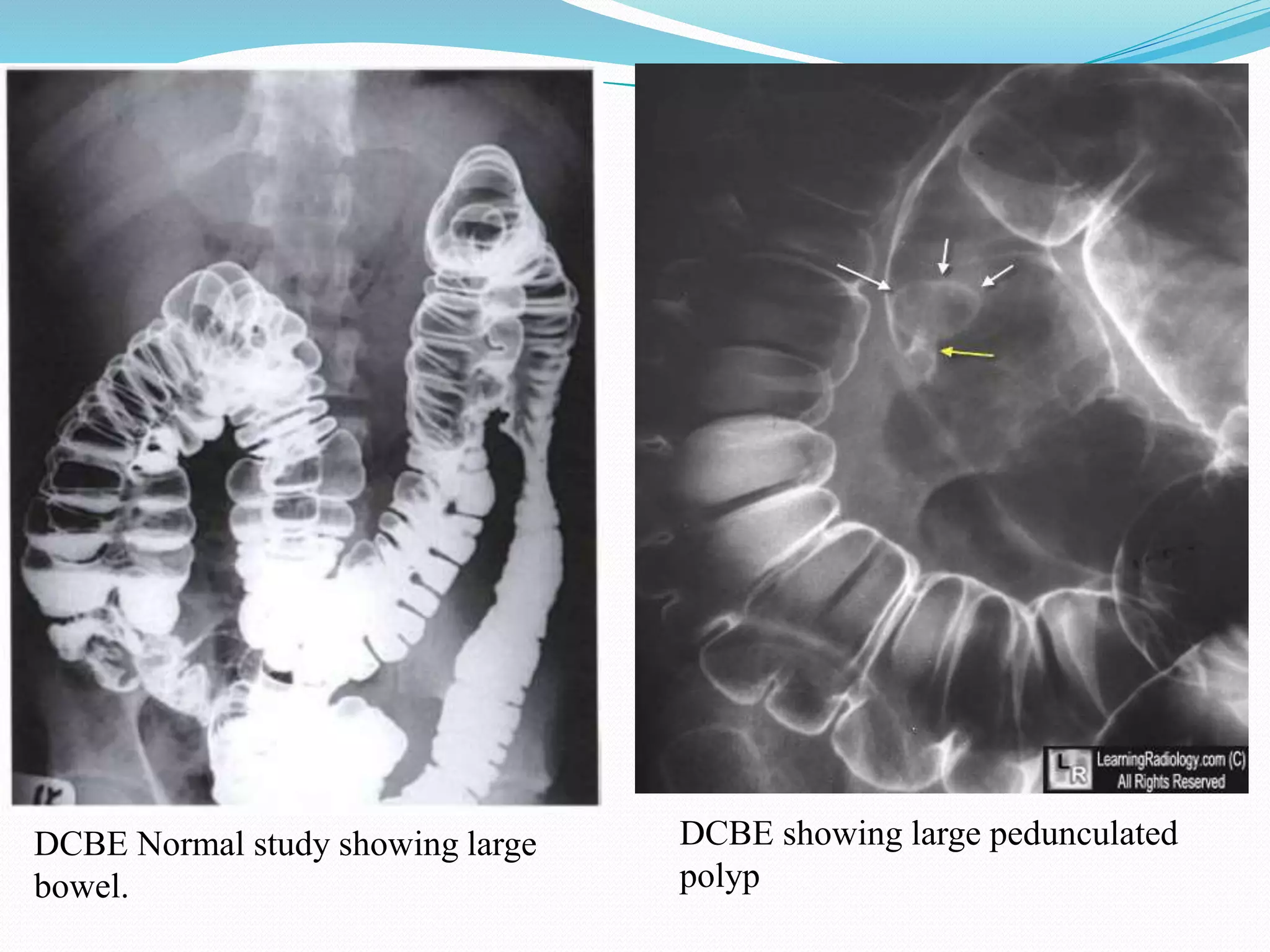 DCBE showing large pedunculated
polyp
DCBE Normal study showing large
bowel.
 