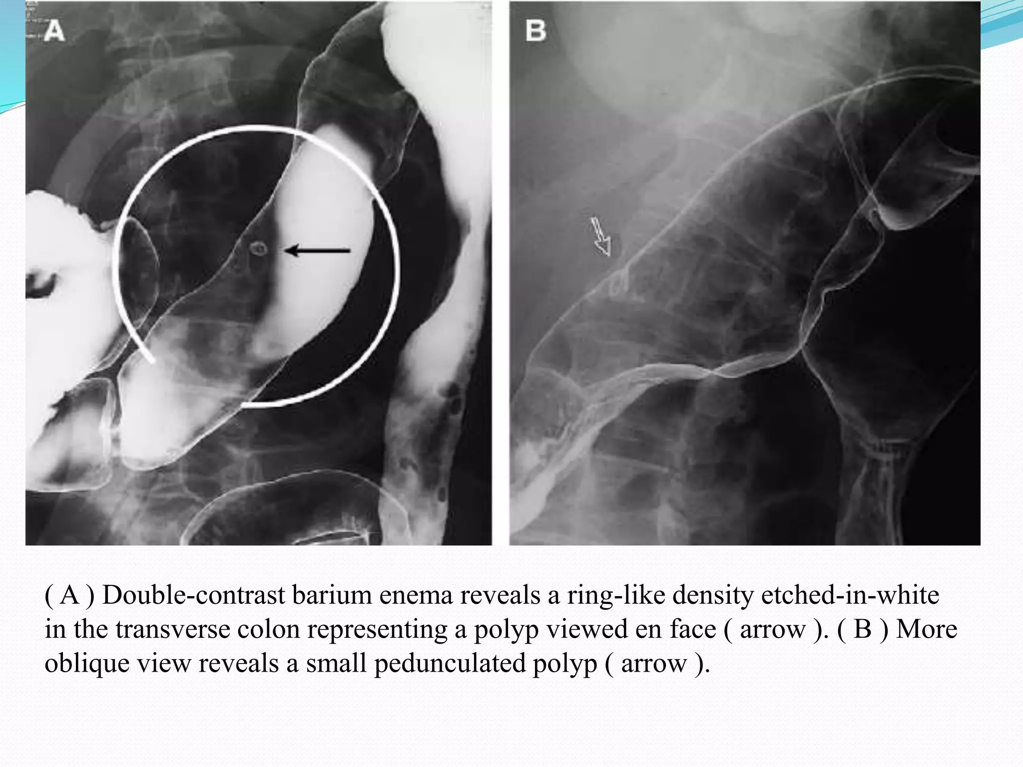 ( A ) Double-contrast barium enema reveals a ring-like density etched-in-white
in the transverse colon representing a polyp viewed en face ( arrow ). ( B ) More
oblique view reveals a small pedunculated polyp ( arrow ).
 