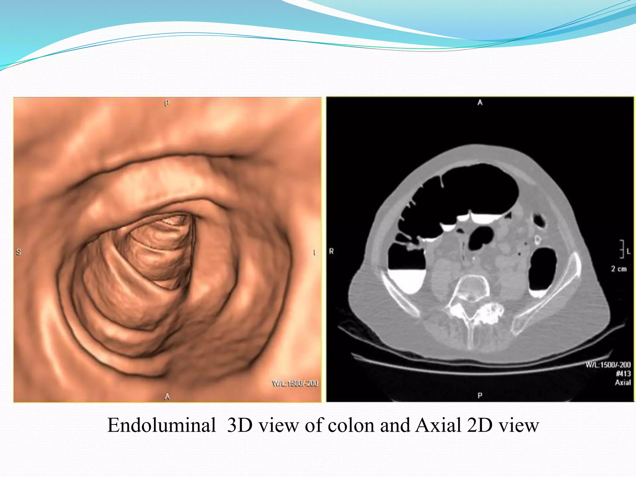 Endoluminal 3D view of colon and Axial 2D view
 