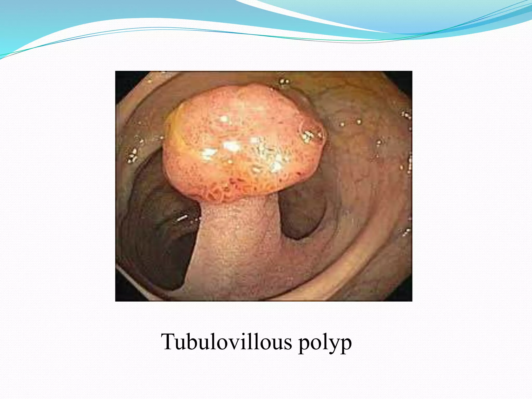 Tubulovillous polyp
 