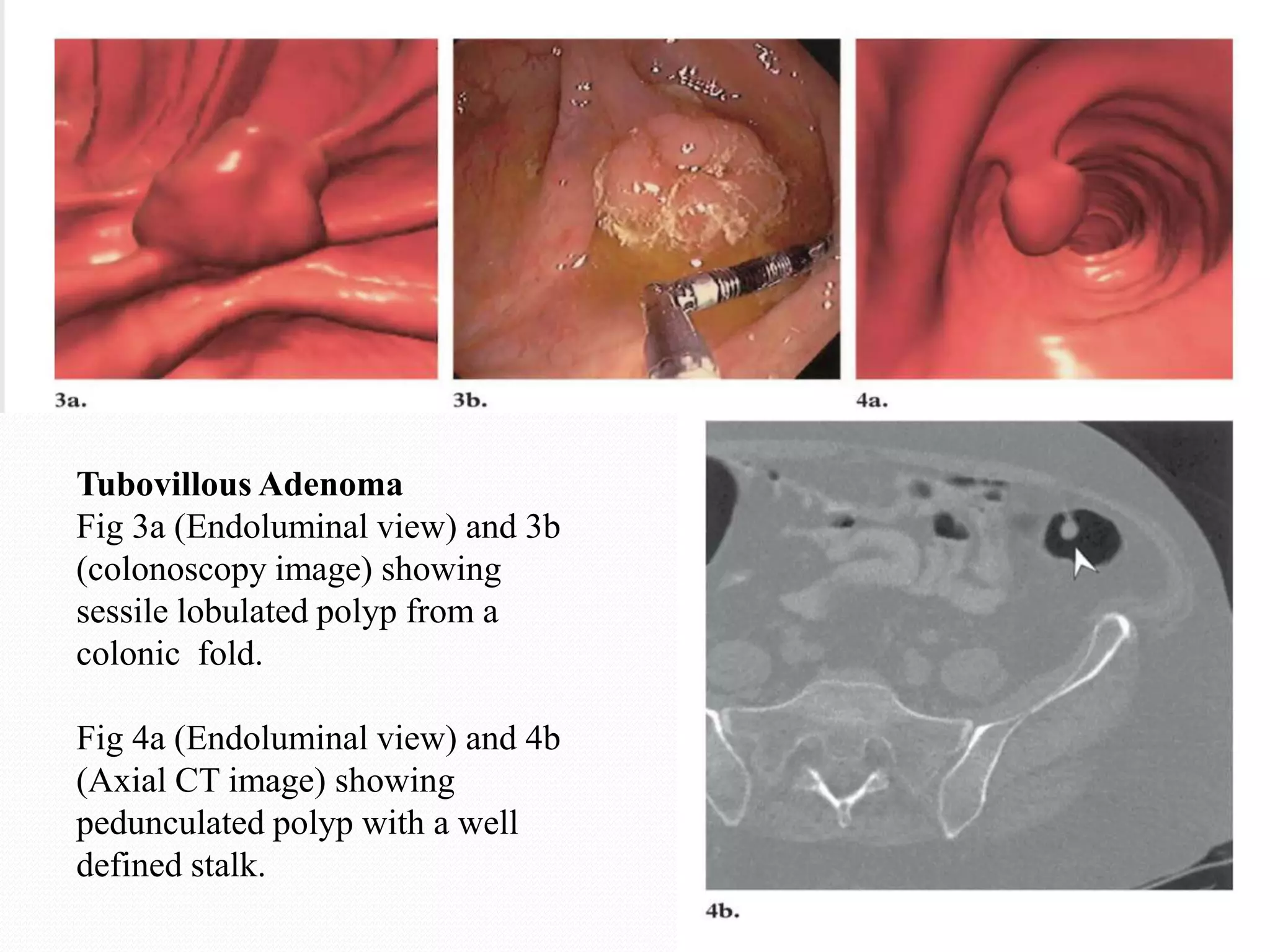 Tubovillous Adenoma
Fig 3a (Endoluminal view) and 3b
(colonoscopy image) showing
sessile lobulated polyp from a
colonic fold.
Fig 4a (Endoluminal view) and 4b
(Axial CT image) showing
pedunculated polyp with a well
defined stalk.
 