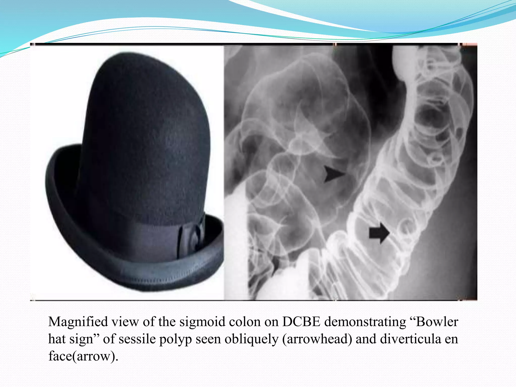 Magnified view of the sigmoid colon on DCBE demonstrating “Bowler
hat sign” of sessile polyp seen obliquely (arrowhead) and diverticula en
face(arrow).
 