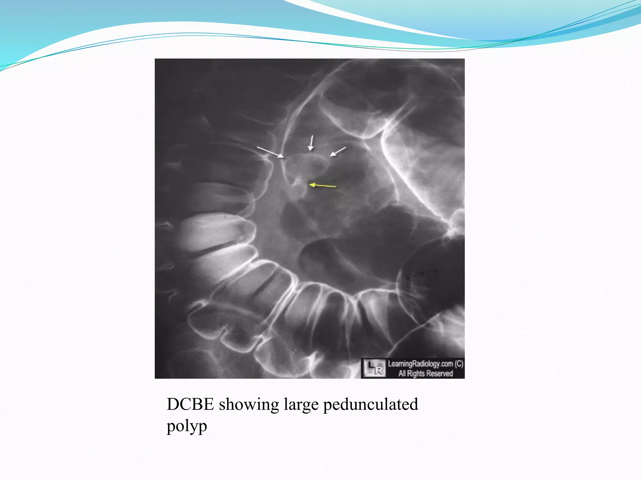 DCBE showing large pedunculated
polyp
 