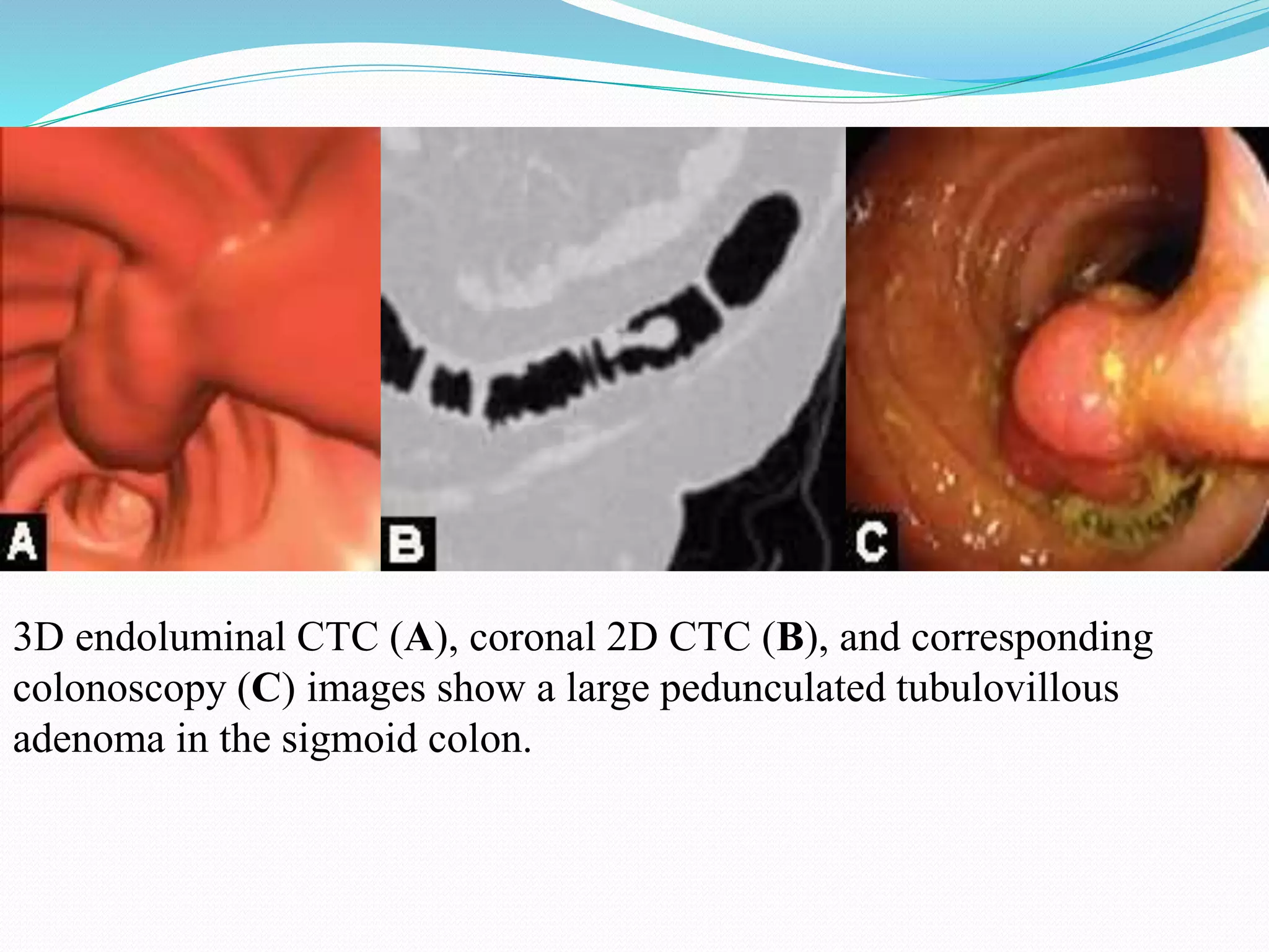 3D endoluminal CTC (A), coronal 2D CTC (B), and corresponding
colonoscopy (C) images show a large pedunculated tubulovillous
adenoma in the sigmoid colon.
 