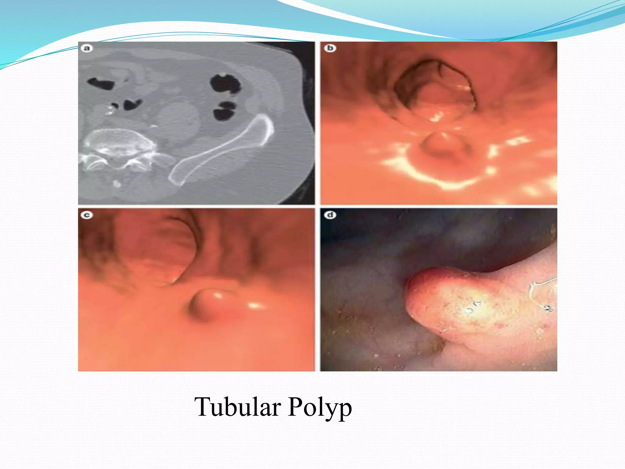 Tubular Polyp
 