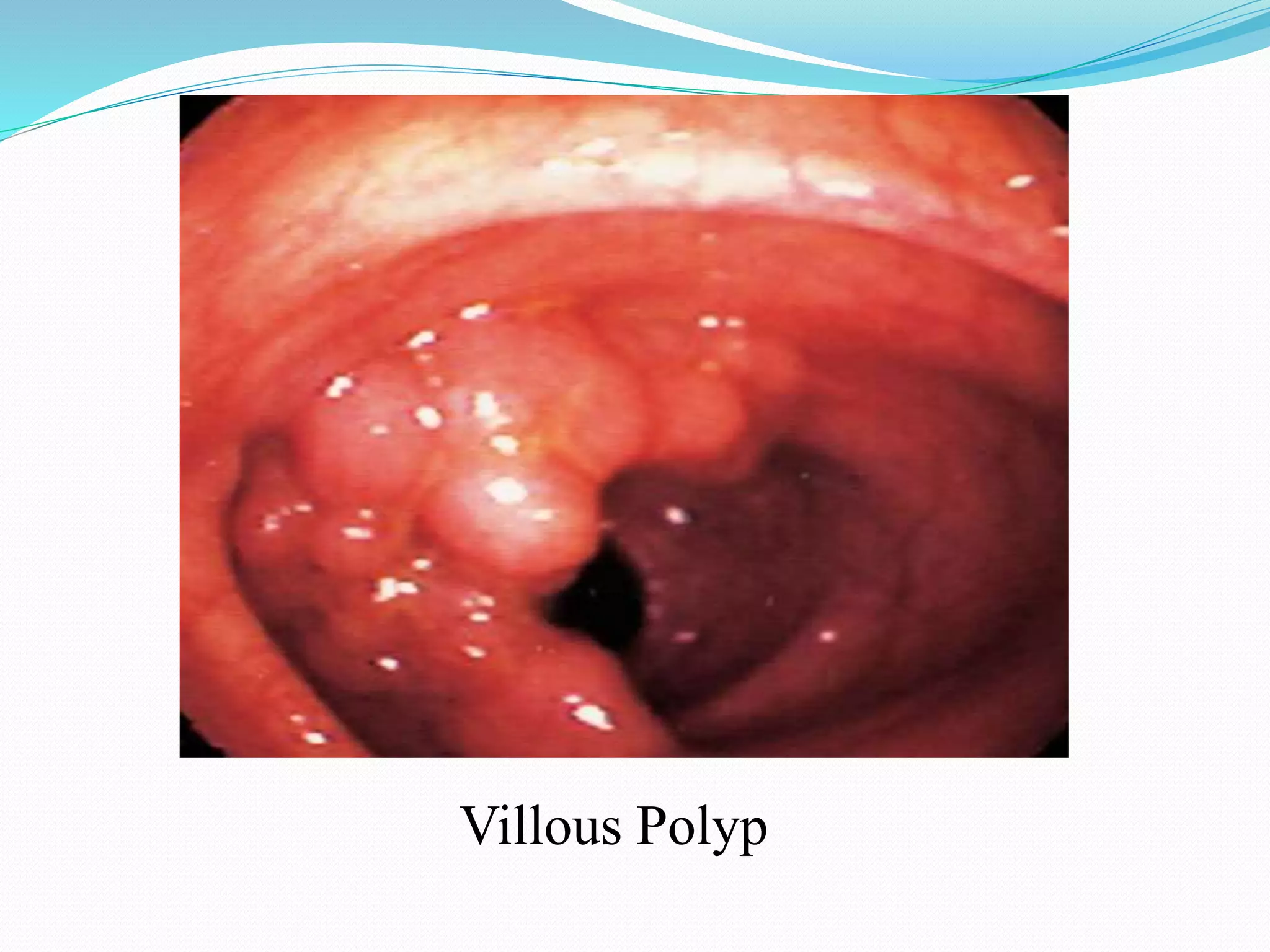 Villous Polyp
 