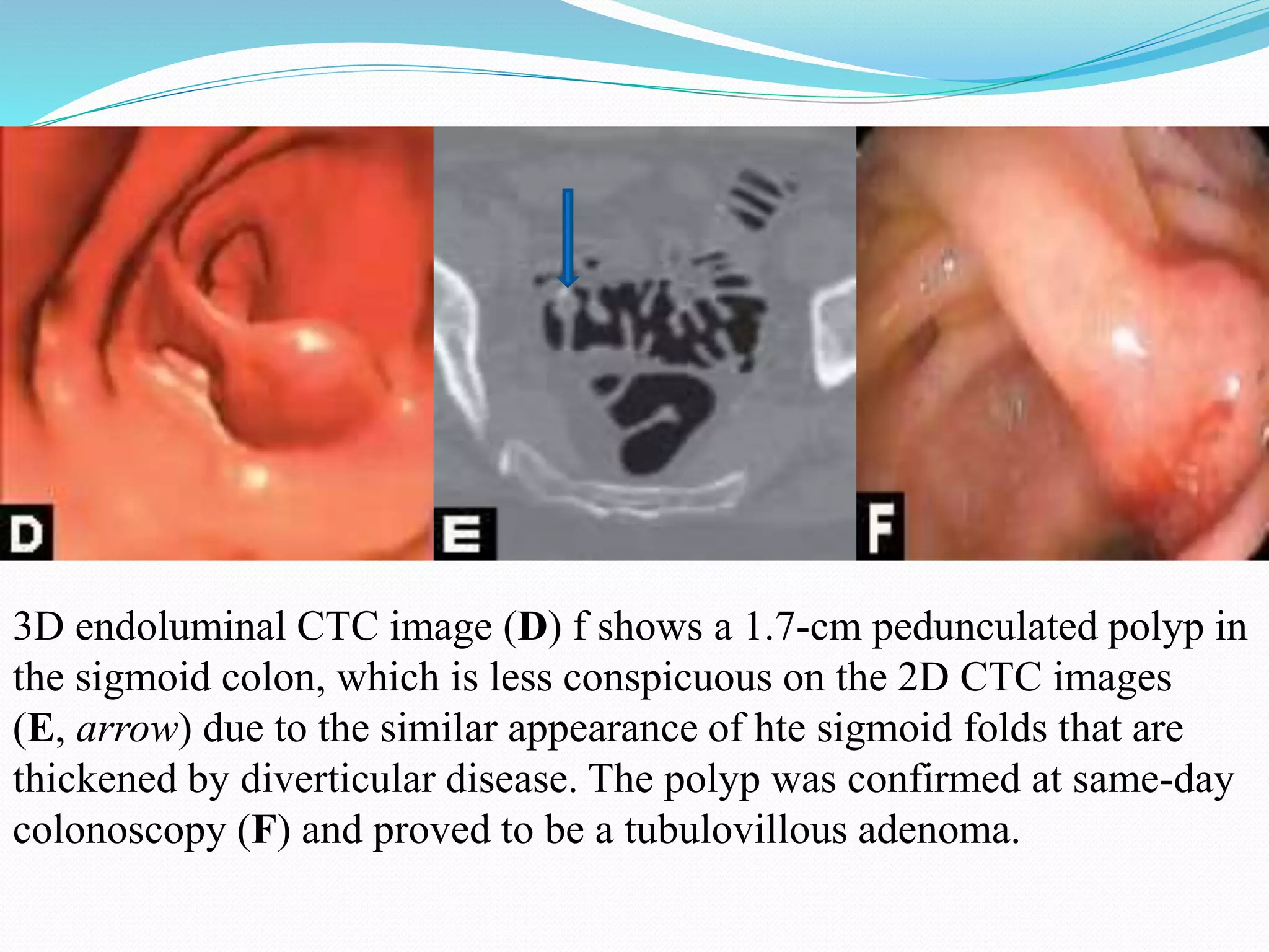 3D endoluminal CTC image (D) f shows a 1.7-cm pedunculated polyp in
the sigmoid colon, which is less conspicuous on the 2D CTC images
(E, arrow) due to the similar appearance of hte sigmoid folds that are
thickened by diverticular disease. The polyp was confirmed at same-day
colonoscopy (F) and proved to be a tubulovillous adenoma.
 