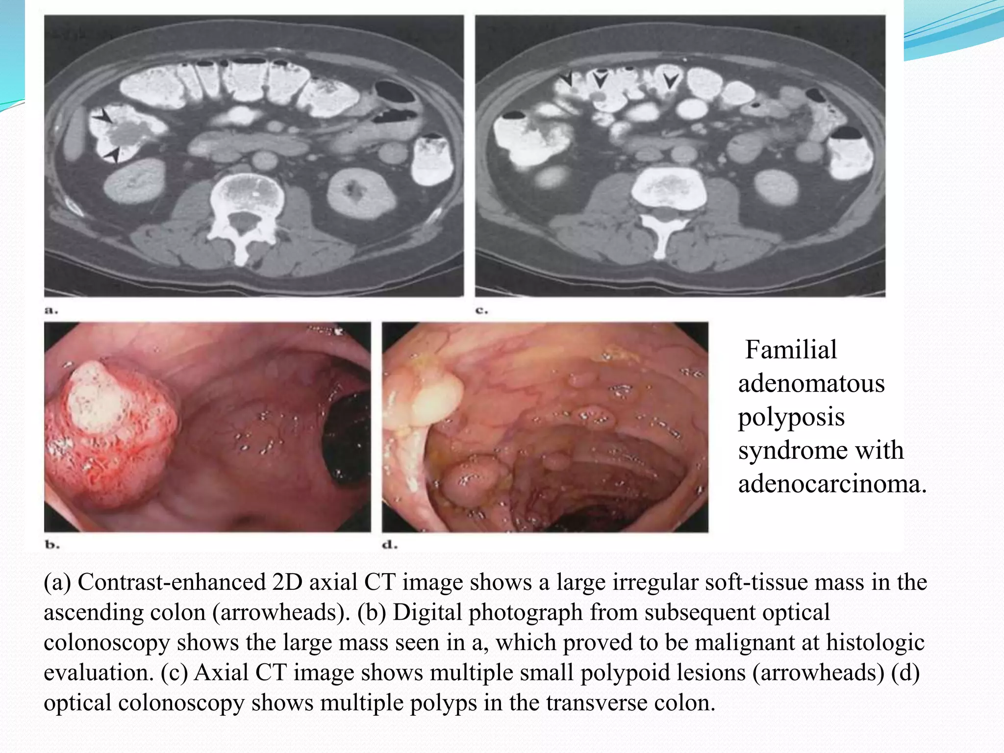 (a) Contrast-enhanced 2D axial CT image shows a large irregular soft-tissue mass in the
ascending colon (arrowheads). (b) Digital photograph from subsequent optical
colonoscopy shows the large mass seen in a, which proved to be malignant at histologic
evaluation. (c) Axial CT image shows multiple small polypoid lesions (arrowheads) (d)
optical colonoscopy shows multiple polyps in the transverse colon.
Familial
adenomatous
polyposis
syndrome with
adenocarcinoma.
 