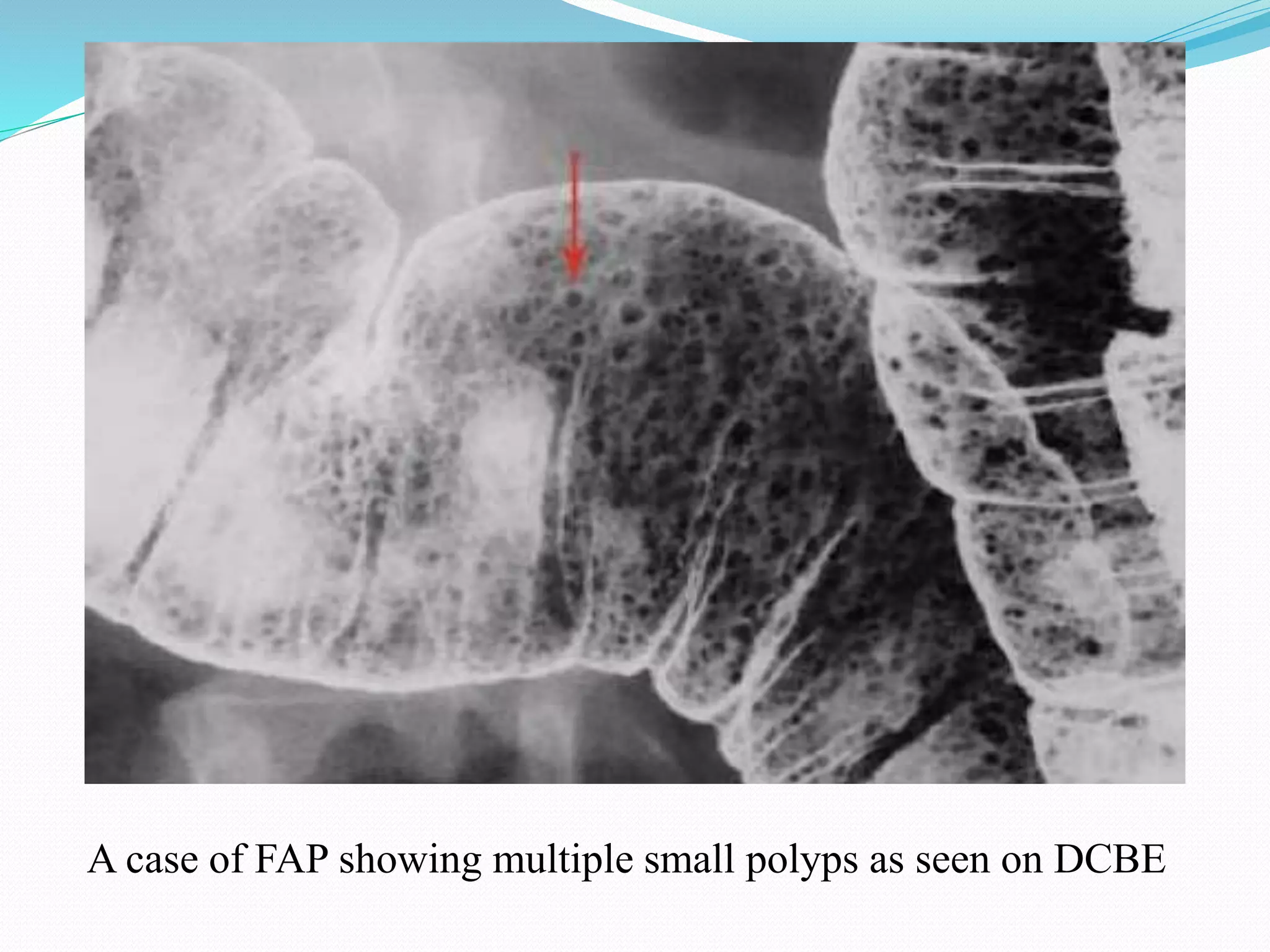 A case of FAP showing multiple small polyps as seen on DCBE
 