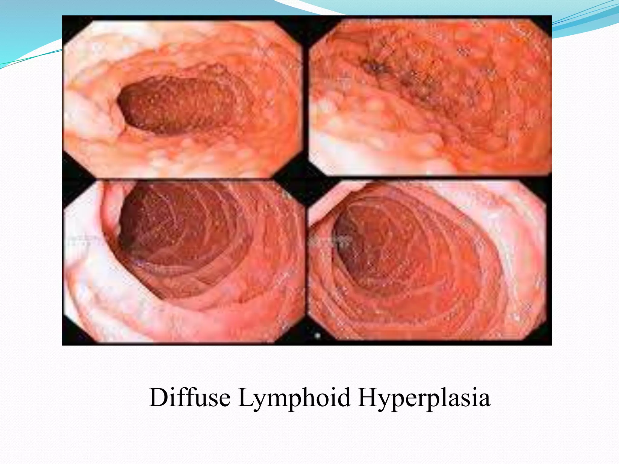 Diffuse Lymphoid Hyperplasia
 