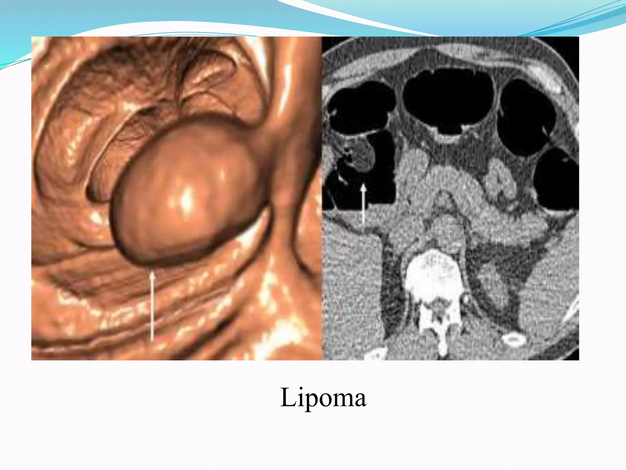 Lipoma
 