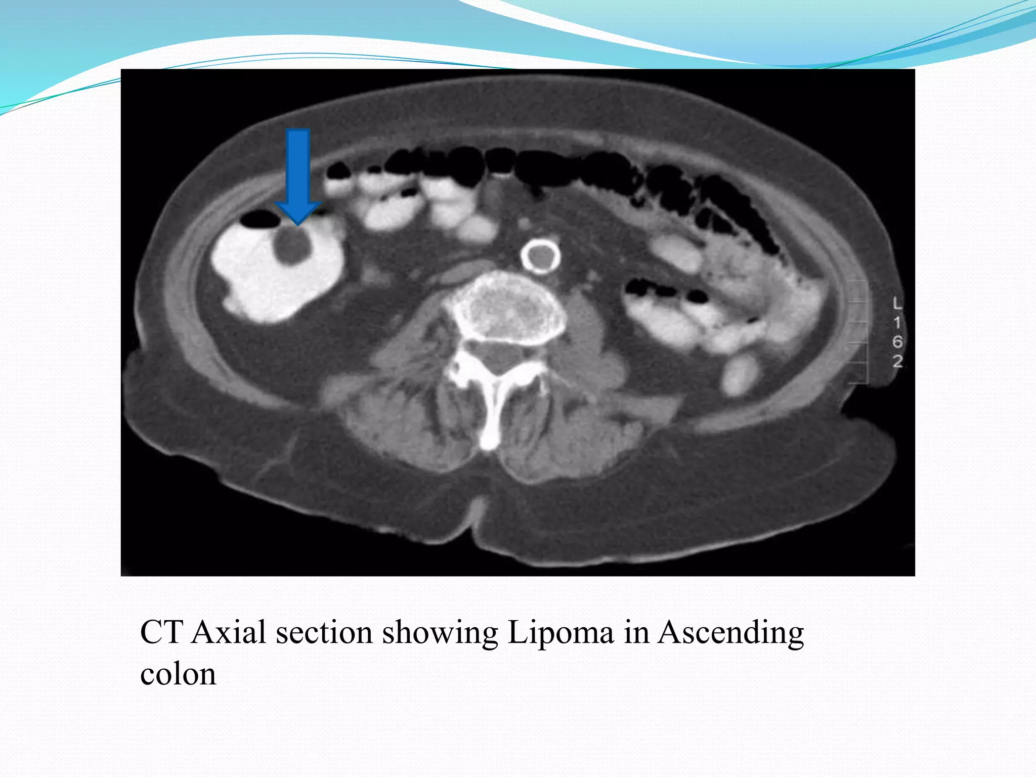 CT Axial section showing Lipoma in Ascending
colon
 