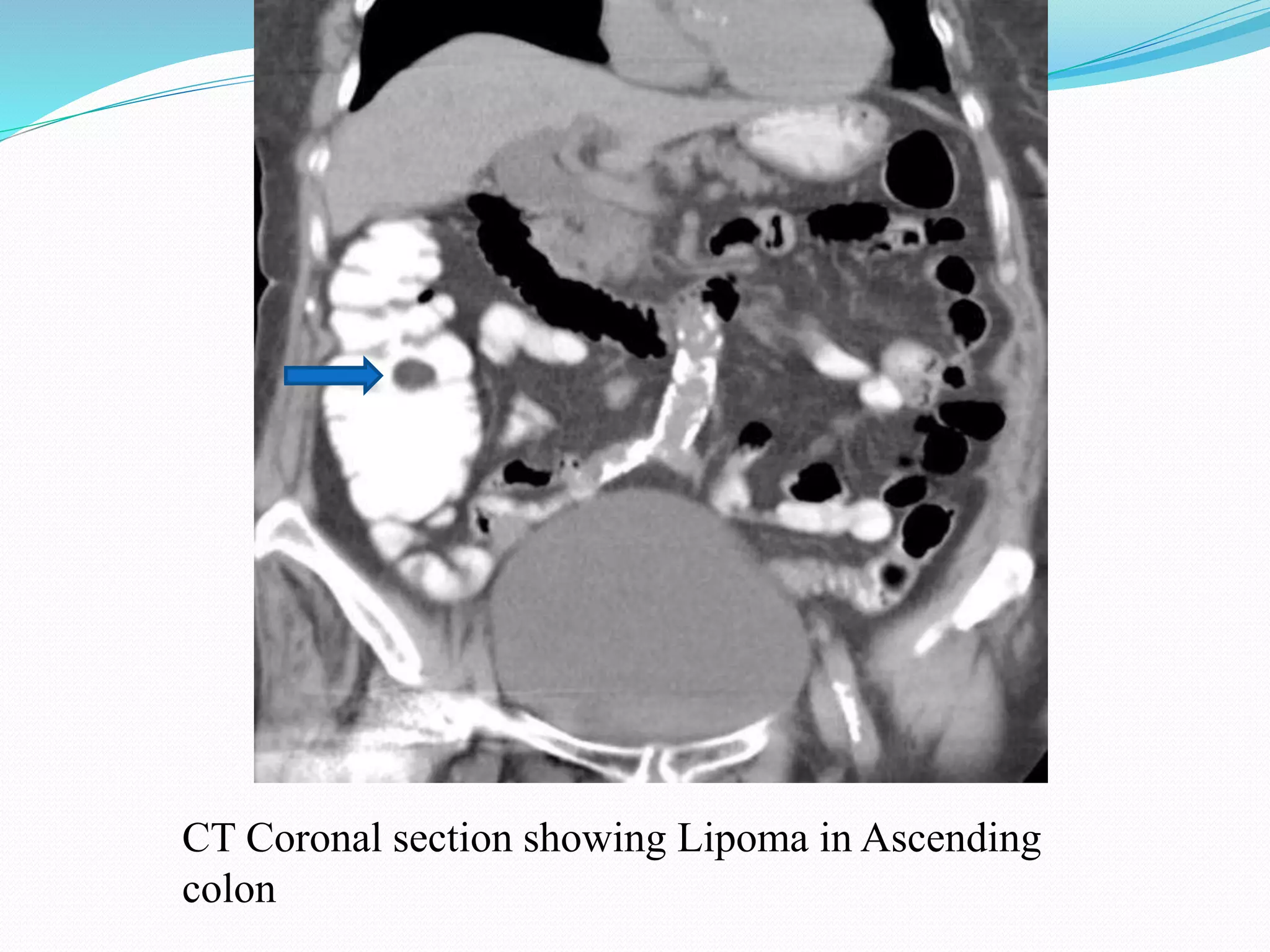 CT Coronal section showing Lipoma in Ascending
colon
 
