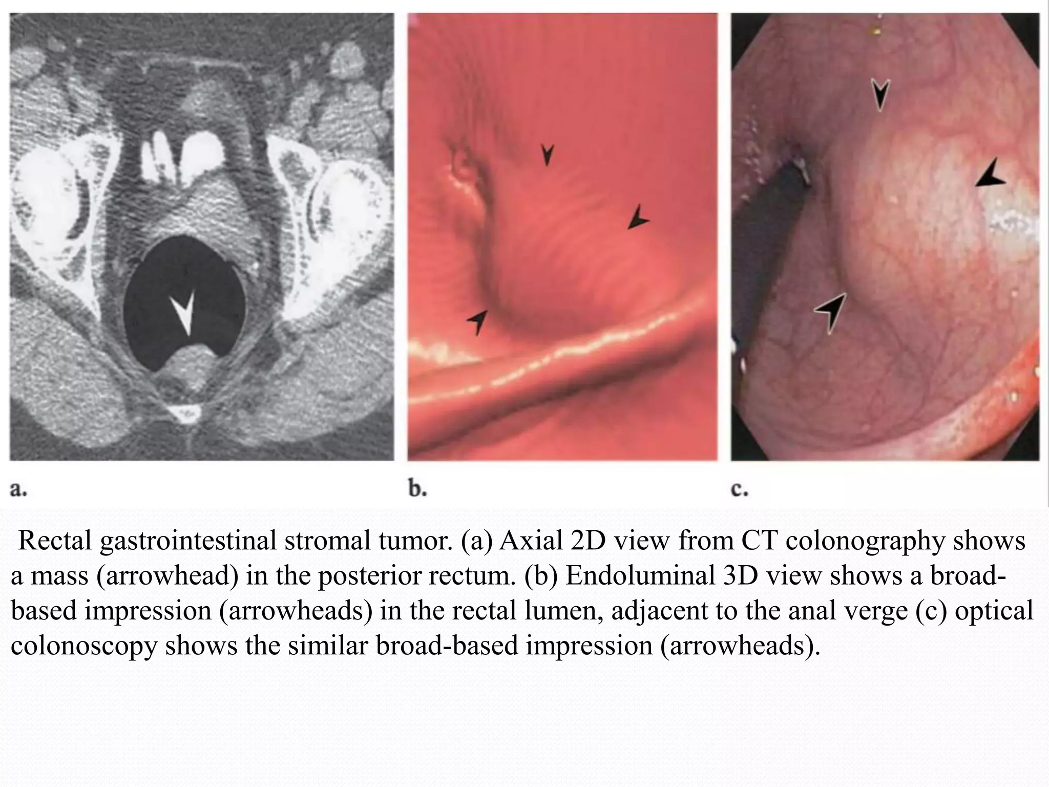 Rectal gastrointestinal stromal tumor. (a) Axial 2D view from CT colonography shows
a mass (arrowhead) in the posterior rectum. (b) Endoluminal 3D view shows a broad-
based impression (arrowheads) in the rectal lumen, adjacent to the anal verge (c) optical
colonoscopy shows the similar broad-based impression (arrowheads).
 