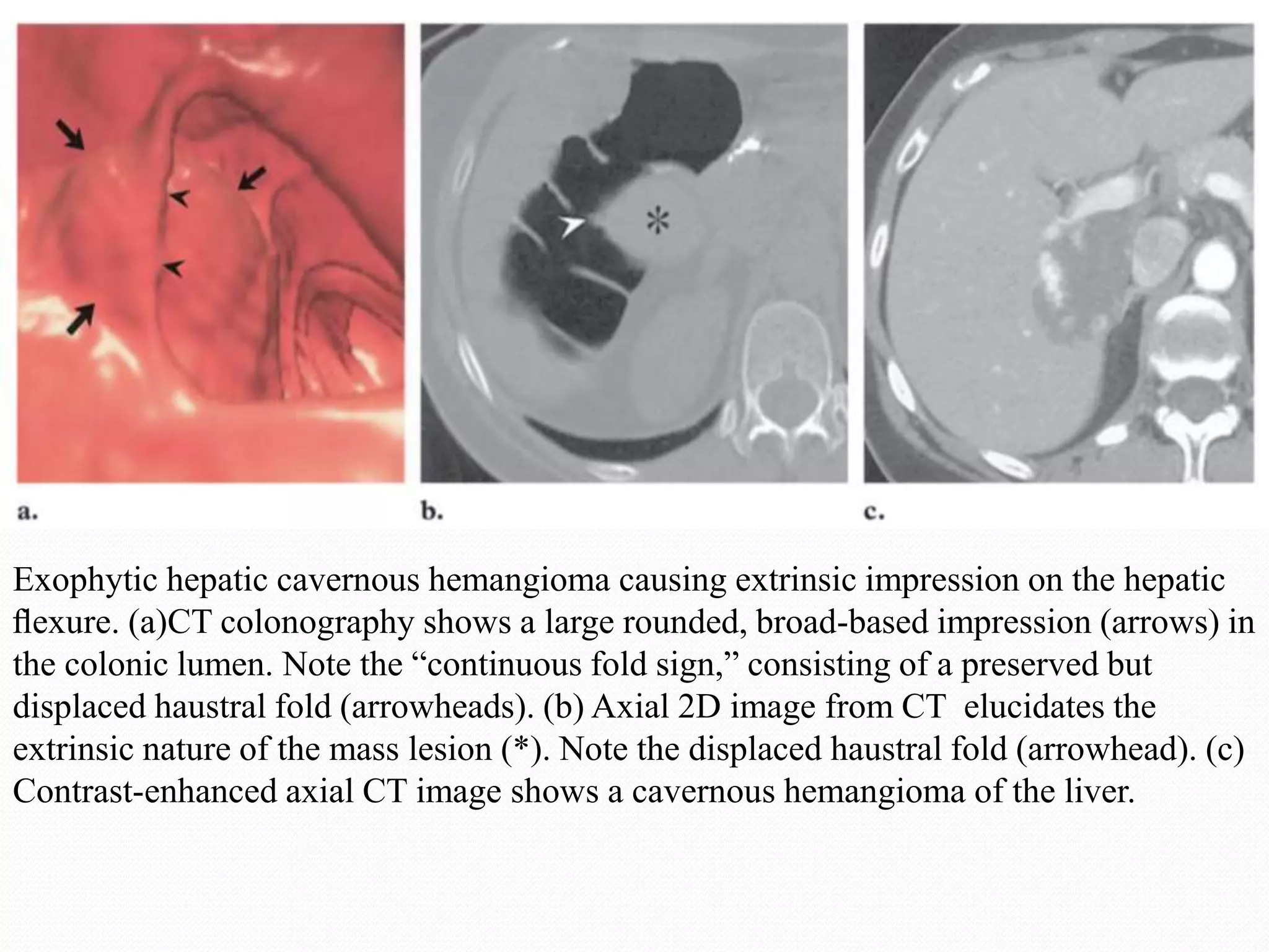 Exophytic hepatic cavernous hemangioma causing extrinsic impression on the hepatic
ﬂexure. (a)CT colonography shows a large rounded, broad-based impression (arrows) in
the colonic lumen. Note the “continuous fold sign,” consisting of a preserved but
displaced haustral fold (arrowheads). (b) Axial 2D image from CT elucidates the
extrinsic nature of the mass lesion (*). Note the displaced haustral fold (arrowhead). (c)
Contrast-enhanced axial CT image shows a cavernous hemangioma of the liver.
 