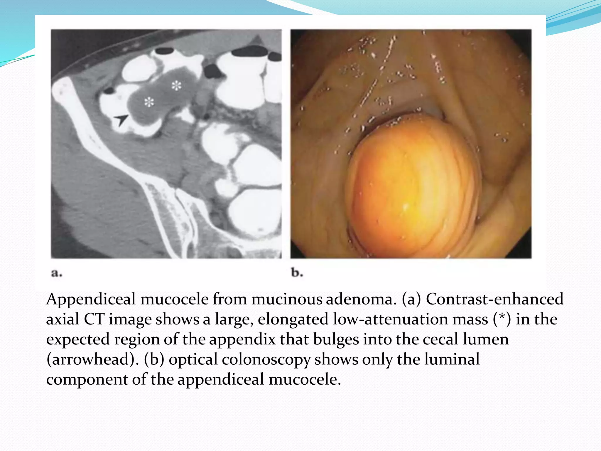 Appendiceal mucocele from mucinous adenoma. (a) Contrast-enhanced
axial CT image shows a large, elongated low-attenuation mass (*) in the
expected region of the appendix that bulges into the cecal lumen
(arrowhead). (b) optical colonoscopy shows only the luminal
component of the appendiceal mucocele.
 