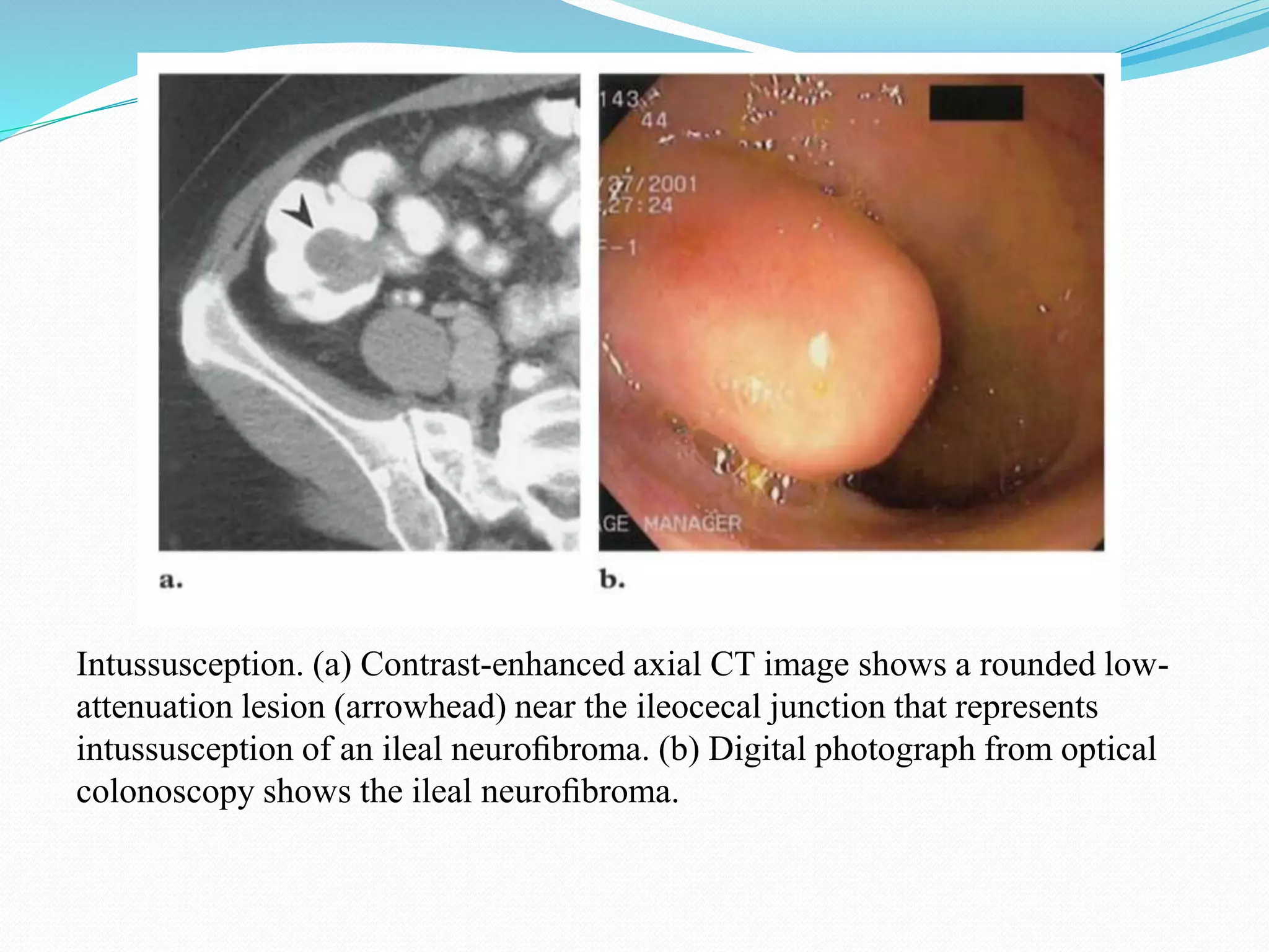 Intussusception. (a) Contrast-enhanced axial CT image shows a rounded low-
attenuation lesion (arrowhead) near the ileocecal junction that represents
intussusception of an ileal neuroﬁbroma. (b) Digital photograph from optical
colonoscopy shows the ileal neuroﬁbroma.
 
