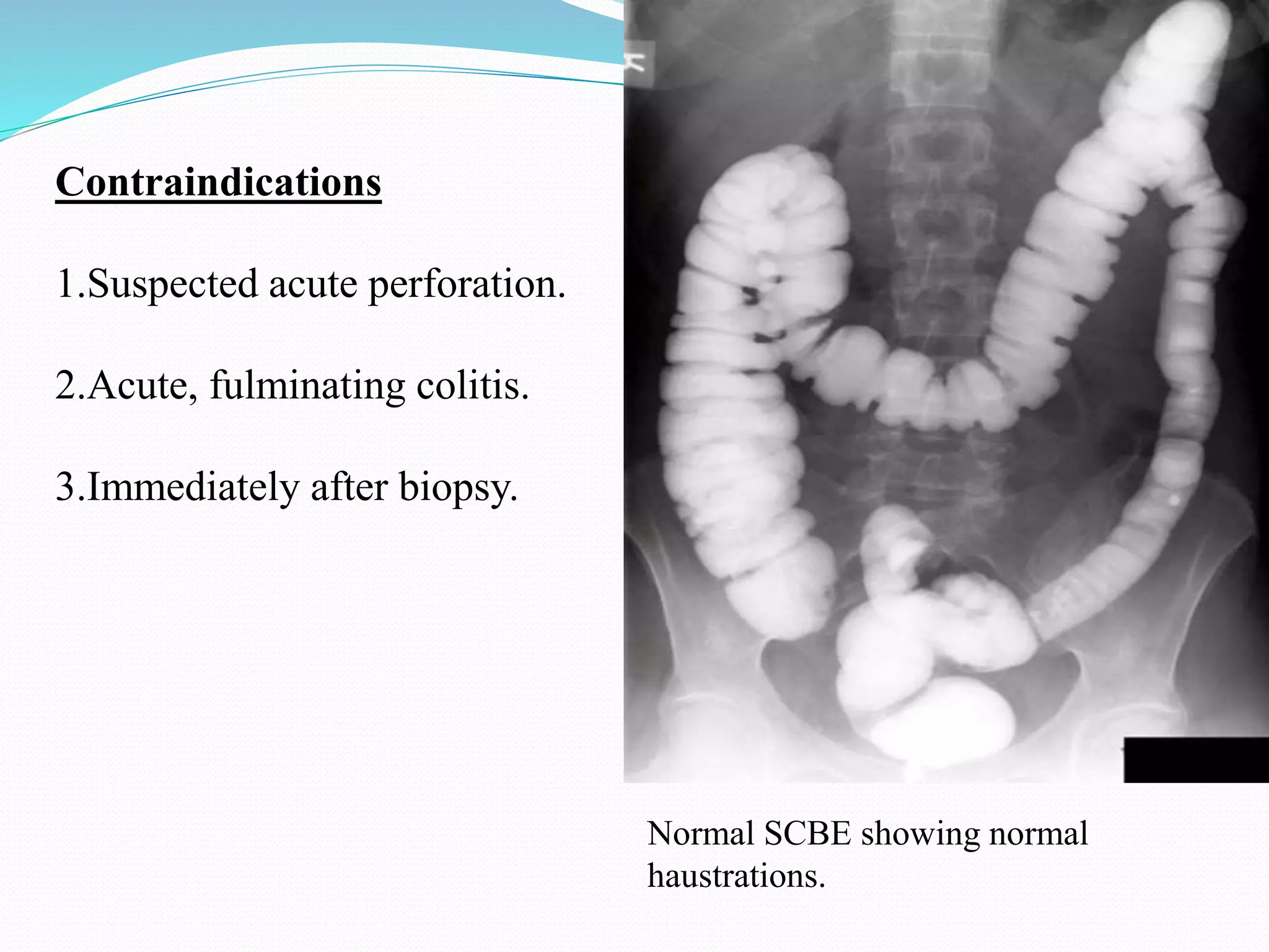 Contraindications
1.Suspected acute perforation.
2.Acute, fulminating colitis.
3.Immediately after biopsy.
Normal SCBE showing normal
haustrations.
 