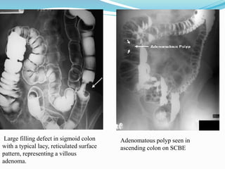 Large filling defect in sigmoid colon
with a typical lacy, reticulated surface
pattern, representing a villous
adenoma.
Adenomatous polyp seen in
ascending colon on SCBE
 