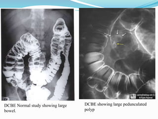 DCBE showing large pedunculated
polyp
DCBE Normal study showing large
bowel.
 