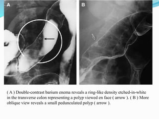 ( A ) Double-contrast barium enema reveals a ring-like density etched-in-white
in the transverse colon representing a polyp viewed en face ( arrow ). ( B ) More
oblique view reveals a small pedunculated polyp ( arrow ).
 