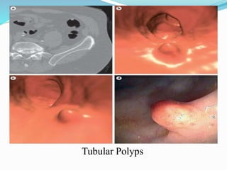 Tubular Polyps
 