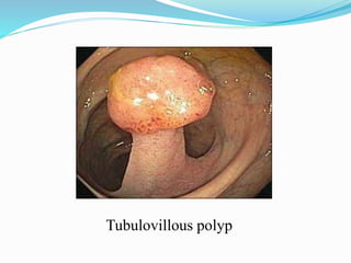 Tubulovillous polyp
 