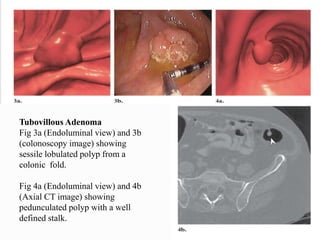 Tubovillous Adenoma
Fig 3a (Endoluminal view) and 3b
(colonoscopy image) showing
sessile lobulated polyp from a
colonic fold.
Fig 4a (Endoluminal view) and 4b
(Axial CT image) showing
pedunculated polyp with a well
defined stalk.
 