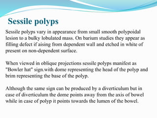 Sessile polyps
Sessile polyps vary in appearance from small smooth polypoidal
lesion to a bulky lobulated mass. On barium studies they appear as
filling defect if aising from dependent wall and etched in white of
present on non-dependent surface.
When viewed in oblique projections sessile polyps manifest as
"Bowler hat" sign.with dome representing the head of the polyp and
brim representing the base of the polyp.
Although the same sign can be produced by a diverticulum but in
case of diverticulum the dome points away from the axis of bowel
while in case of polyp it points towards the lumen of the bowel.
 