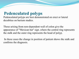 Pedenculated polyps
Pedenculated polyps are best demonstrated on erect or lateral
decubitus on barium studies.
Those arising from non-dependent wall of colon give the
appearance of "Mexican hat" sign ,where the central ring represents
the stalk and the outer ring represents the head of polyp.
In these cases the change in position of patient shows the stalk and
confirms the diagnosis.
 