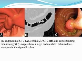 3D endoluminal CTC (A), coronal 2D CTC (B), and corresponding
colonoscopy (C) images show a large pedunculated tubulovillous
adenoma in the sigmoid colon.
 