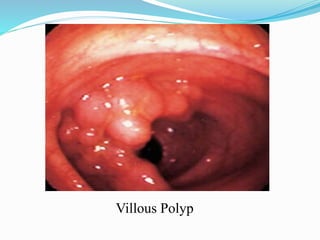 Villous Polyp
 