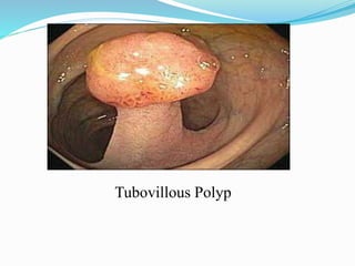 Tubovillous Polyp
 