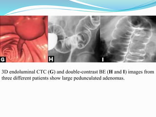 3D endoluminal CTC (G) and double-contrast BE (H and I) images from
three different patients show large pedunculated adenomas.
 