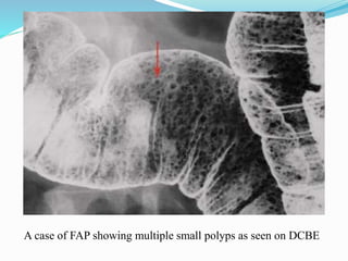 A case of FAP showing multiple small polyps as seen on DCBE
 